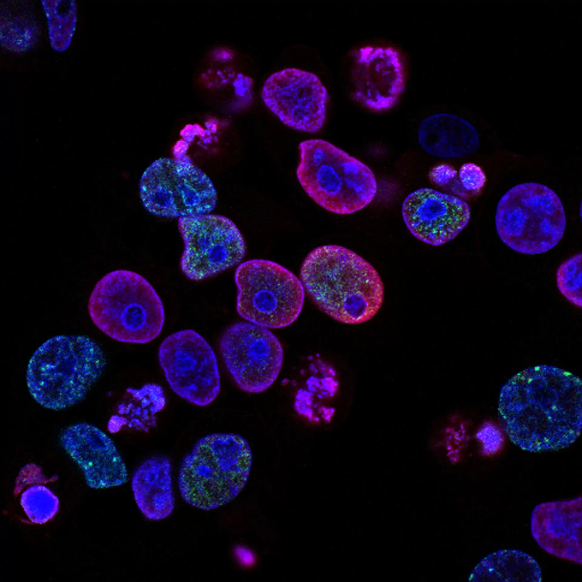 Menschliche Krebszellen, die mit einer Arzneimittelkombination behandelt wurden, die als Krebstherapie untersucht wird. Zellkerne sind blau gefärbt; DNA-Schäden sind in Rot markiert und Herde der DNA-Replikation in Grün.